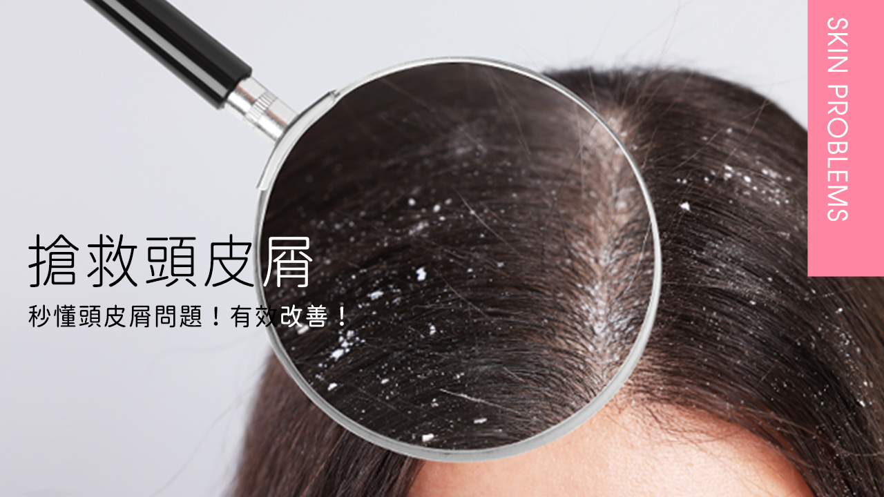 【搶救頭皮屑大作戰】秒懂頭皮屑問題！有效改善、讓你不再雪花滿天飛！