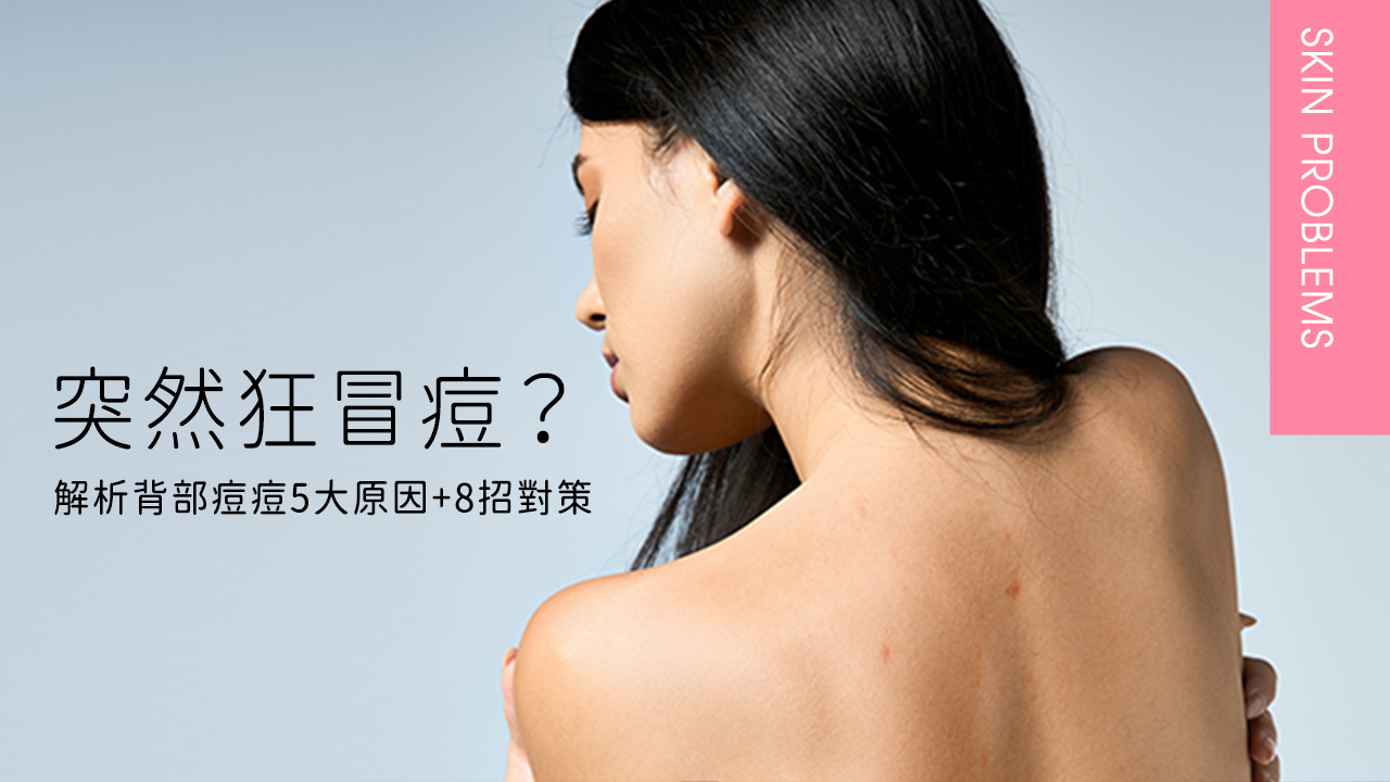 背上突然長很多痘痘怎麼辦？冬天也難倖免？解析背部痘痘5原因＋8招對策